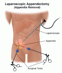 top-nyc-surgeon-for-laparoscopic-appendectomy-appendicitis-01