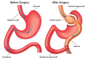 stomach-surgery-medical-information-best-surgeons-nyc-02