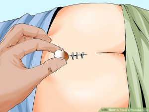 Pilonidal-Cyst