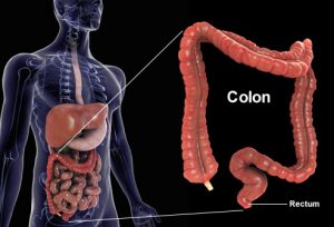 colon surgery