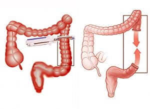 Colon cancer