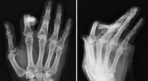 Phalangeal fracture