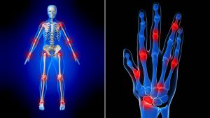 best-rheumatoid-arthritis-dr-nyc-01