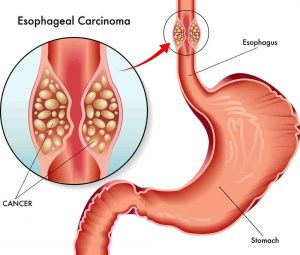 esophageal-cancer-surgeons-minimally-invasive-esophagectomy-nyc-02