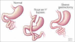 top-gastric-bypass-surgeons-surgeon-ny-nyc-01