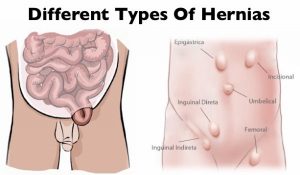 best-hernia-repair-surgeon-experts-nyc-info-process-prognosis-01