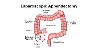 laparoscopic-appendectomy-info-procedure-surgical-experts-02