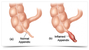 nyc-appendix-removal-surgeons-specialists-03