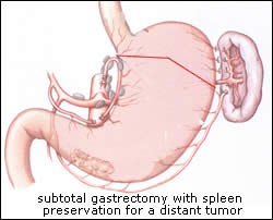 gastrointestinal-surgery-info-expert-stomach-surgeons-03
