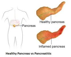healthy-vs-inflamed-pancreas-top-nyc-surgeons-cancer-02