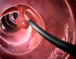 colorectal-cancer-medical-information-nyc-surgeons-02
