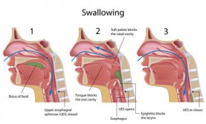 dysphagia-surgery-problems-swallowing-nyc-surgeon-specialists-01