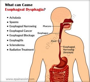 esophageal-dysphagia-general-information-top-nyc-experts-02