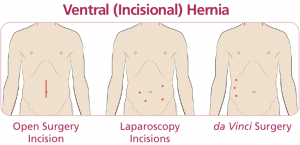 hernia-repair-surgery-methods-faq-info-02