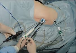 laproscopic-adrenal-surgery-nyc-03