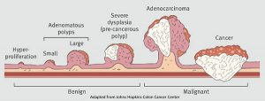 Colorectal Cancer Surgery: Steps, Benefits, Side-Effects, Precautions ...