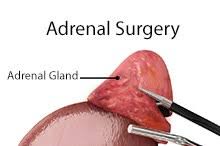 top-nyc-doctors-adrenal-surgery-info-01