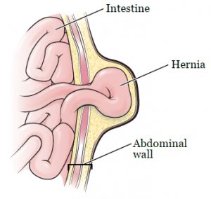 top-nyc-hernia-repair-surgeons-info-01