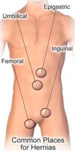 causes-symptoms-hernias-01