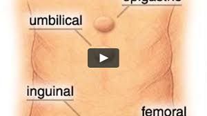 what-is-hernia-causes-nyc-specialist-surgeons-03