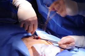hernia-repair-surgery-surgeons-03