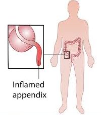 appendix-surgery-best-surgeons-nyc-01
