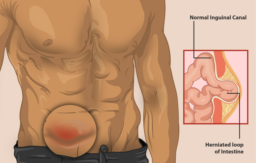 best hernia repair surgeons nyc 2023 2024