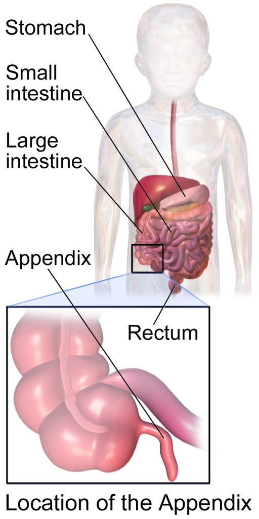 Appendicitis and Surgical Interventions