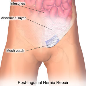 hernia repair surgery Inguinal_Hernia_Patch