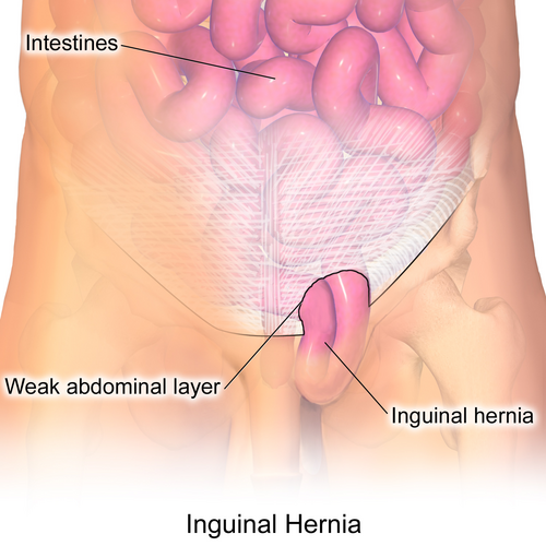 Lenox Hill Surgeons Expertise in Hernia Repair Surgery