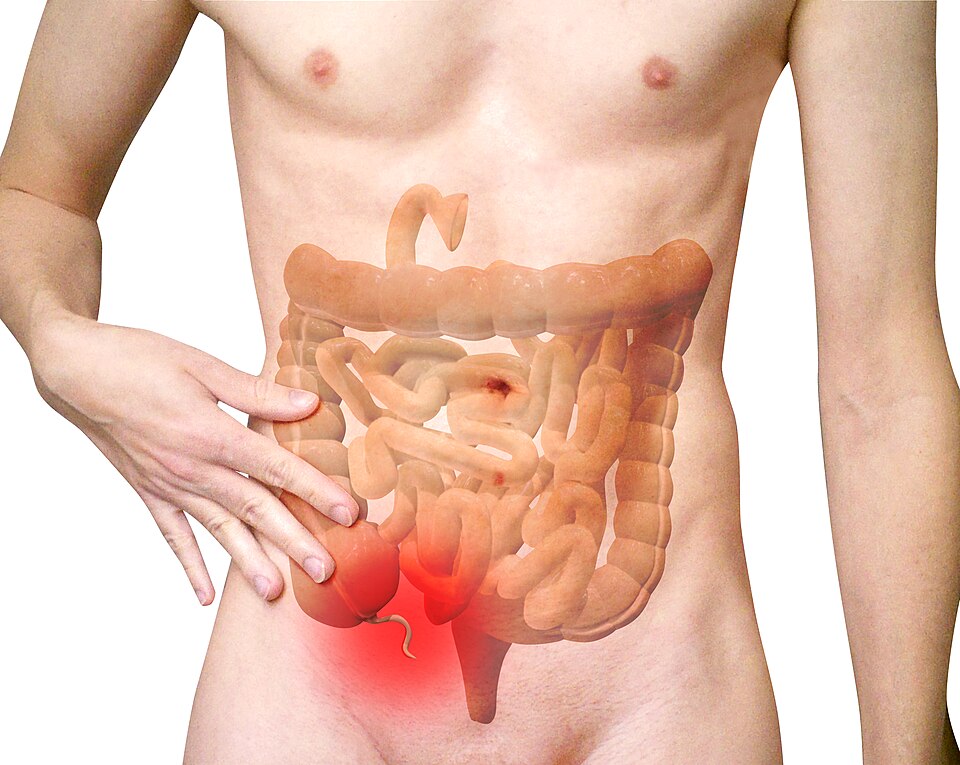Appendectomy Explained What NYC Patients Should Know About Appendix Surgery
